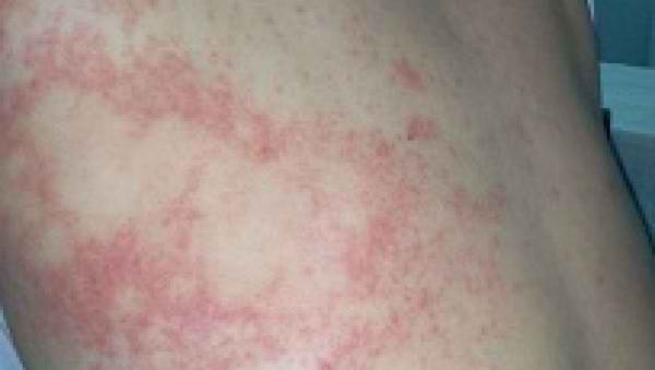 Nguyên nhân do viêm nhiễm: Do bụi bặm, vi khuẩn và nấm mốc, bào tử, ký sinh trùng khiến cơ thể viêm nhiễm cũng có thể nổi mề đay. Một số người quá mẫn cảm thì khi bị muỗi độc cắn cũng có thể bị nổi mề đay. Nguồn ảnh: tudienthuoc.org.