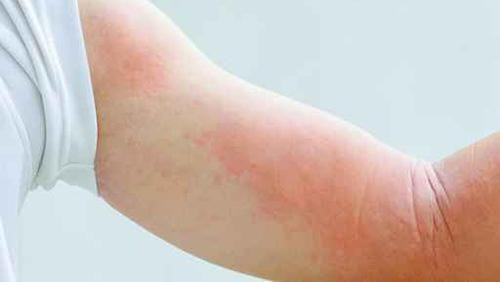 Nguyên nhân do yếu tố tâm lý và yếu tố di truyền. Có người do quá căng thẳng tâm lý cũng có thể khiến bị nổi mề đay. Nhiều người do di truyền từ cha mẹ. Khi bị nổi mề đay bạn có thể tham khảo phương thuốc cổ chữa trị chứng mề đay một cách rất đơn giản mà hiệu quả. Nguồn ảnh: Eastday.