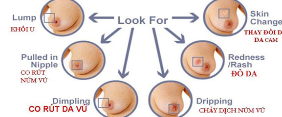 hoặc tĩnh mạch bị giãn và dễ thấy.