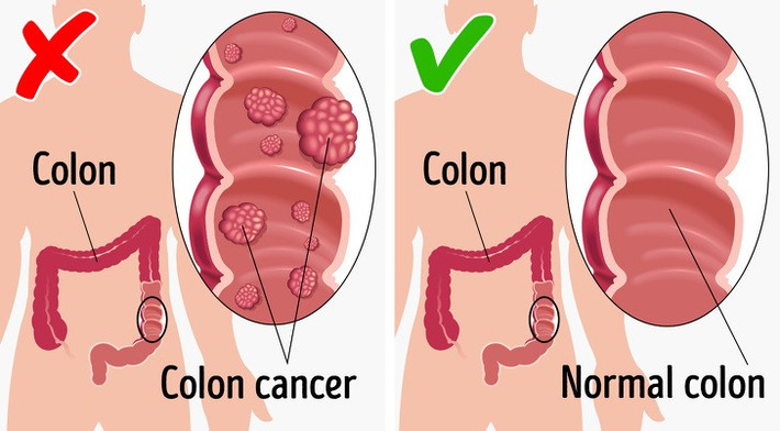 3. Nguy cơ ung thư sẽ giảm bớt Fisetin, flavonoid có trong dưa chuột có đặc tính chống oxy hóa và chống viêm - giảm nguy cơ đối với các loại ung thư.