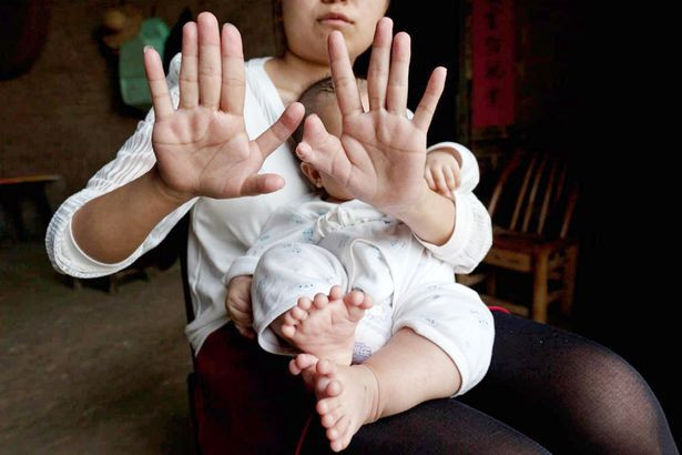 Căn bệnh này có thể di truyền từ mẹ, người mang 6 ngón trên mỗi bàn tay, chân. Hiện tại, cha mẹ của Hong Hong đang cố gắng gây quỹ lấy tiền phẫu thuật cắt bỏ ngón tay, ngón chân thừa cho con.
