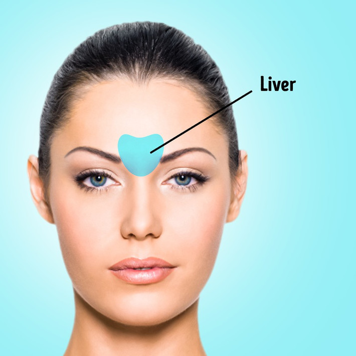 Mụn ở ấn đường: Đây là khu vực giữa 2 đường chân mày. Gan có vấn đề có thể gây ra mụn ở ấn đường. Hoặc có thể do chế độ ăn của bạn có quá nhiều dầu mỡ.
