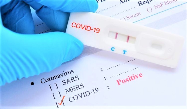 Làm thế nào hạn chế 'dương tính giả' khi test nhanh Covid-19? - Hình 2 Lam the nao han che 'duong tinh gia' khi test nhanh Covid-19?-Hinh-2