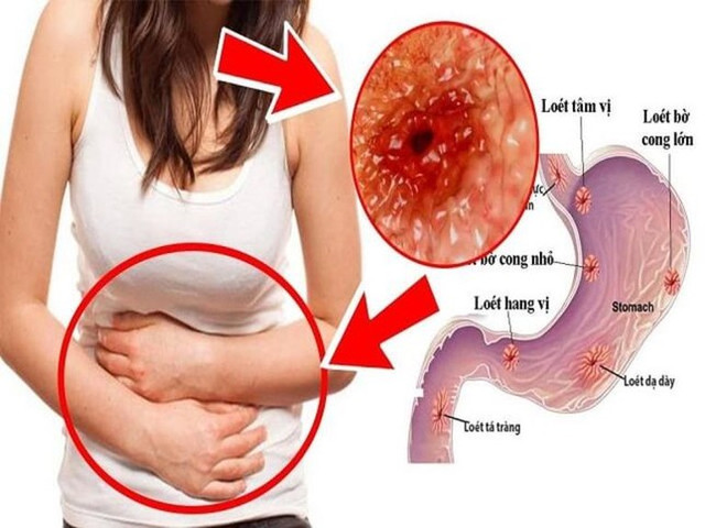 Đau dạ dày nên tránh tuyệt đối những thực phẩm này Dau da day nen tranh tuyet doi nhung thuc pham nay