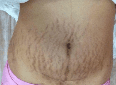 Người chồng phát hiện nếp rạn da trên bụng vợ trong đêm tân hôn đã đuổi cô ra khỏi nhà - Hình 2 Nguoi chong phat hien nep ran da tren bung vo trong dem tan hon da duoi co ra khoi nha-Hinh-2