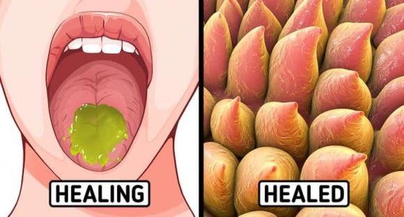 Ăn lẩu, nướng nhiều bị bỏng rát lưỡi và 10 cách chữa lành cấp tốc - Hình 5 An lau, nuong nhieu bi bong rat luoi va 10 cach chua lanh cap toc-Hinh-5