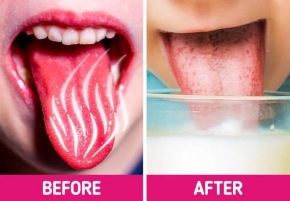 Ăn lẩu, nướng nhiều bị bỏng rát lưỡi và 10 cách chữa lành cấp tốc - Hình 2 An lau, nuong nhieu bi bong rat luoi va 10 cach chua lanh cap toc-Hinh-2