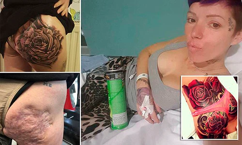 Bà mẹ trút bỏ mặc cảm bằng cách xăm đè lên sẹo áp-xe