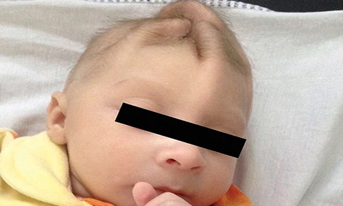 Sự tàn phá khủng khiếp của virus Zika tới não thai nhi