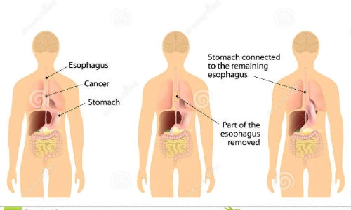 Bệnh trào ngược thực quản có thể dẫn đến ung thư