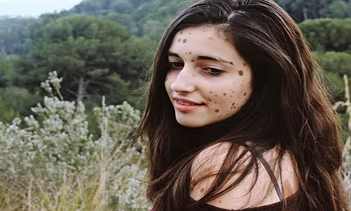 Thiếu nữ nốt ruồi đầy người dũng cảm thành người mẫu