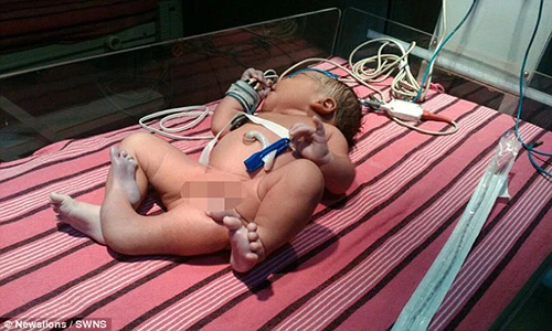 Bé sơ sinh mắc dị tật hiếm: Bẩm sinh đã có 3 chân