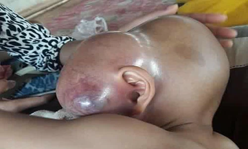 Thương tâm bé 2 tuổi bị u khổng lồ choán hết mặt