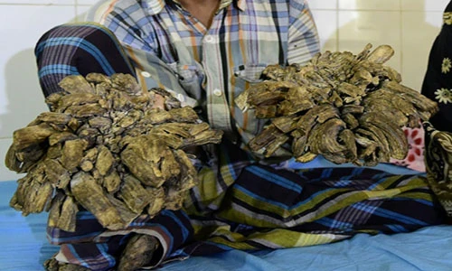 Chàng trai “người cây” thoát bệnh hiểm sau 16 lần phẫu thuật