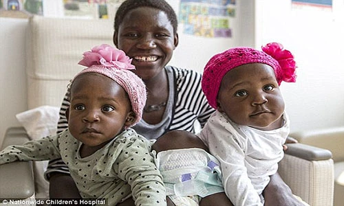 Cặp song sinh dính liền tự đi được sau phẫu thuật tách rời