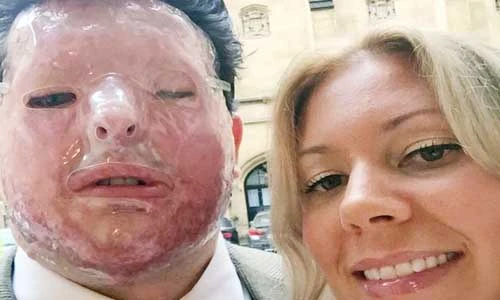 Cuộc sống khổ sở của một nạn nhân bị tạt nhầm axit