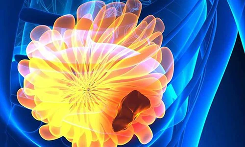 Cẩn trọng 4 dấu hiệu ung thư vú bạn chưa từng nghe