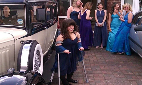 Thiếu nữ chấp nhận đau đớn phẫu thuật kéo dài chân thêm 18cm