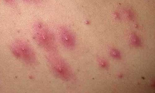 Sai lầm phổ biến hàng ngày khiến vòng 3 mọc mụn 