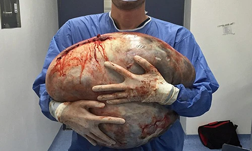 Kinh hãi khối u khổng lồ nặng bằng 10 bé sơ sinh