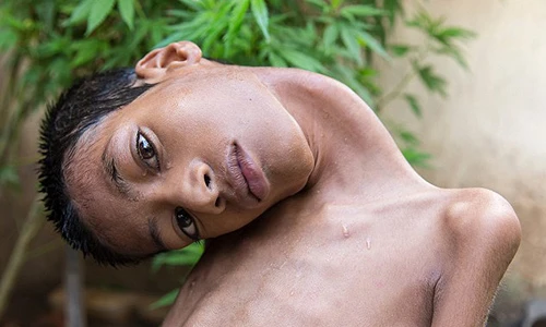 Cái kết buồn lòng của cậu bé có đầu nghiêng 180 độ