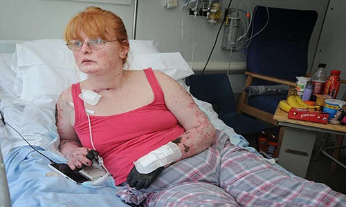 Bà mẹ phải cắt cụt tay chân vì nhiễm trùng máu