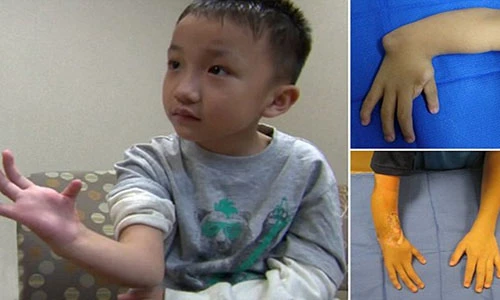 Bé 8 tuổi được ghép ngón chân làm ngón tay