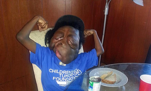 Thương tâm cậu bé “quái vật” bị khối u gây biến dạng khuôn mặt