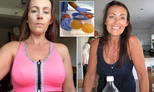 Nhiễm độc suýt chết vì silicon nâng ngực thoái hóa