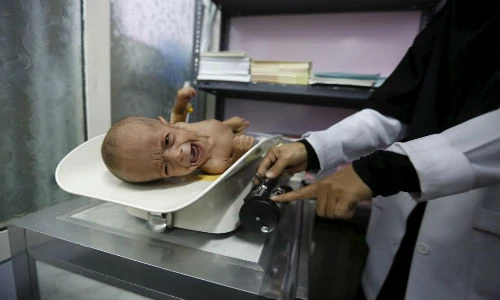 Chùm ảnh đau lòng về nạn đói ở Yemen