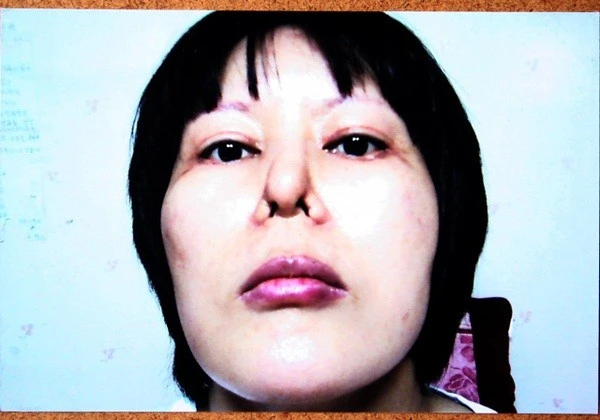 Hình ảnh đáng sợ về phẫu thuật thẩm mỹ thất bại