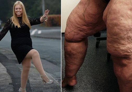 Người phụ nữ hút 12 lít mỡ thừa ở chân để giảm béo