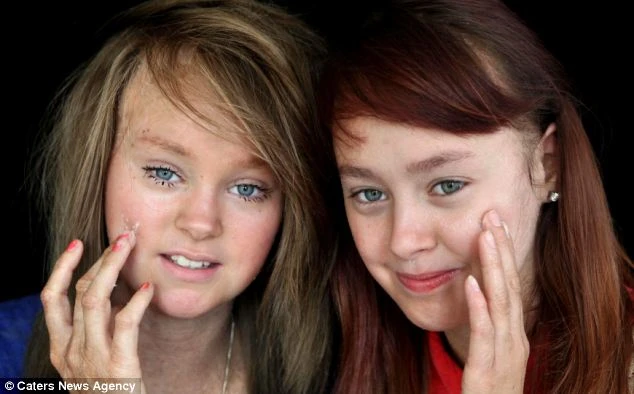 Hai chị em "lột xác” 26kg da mỗi năm