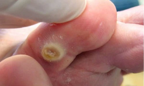 Mẹo trị mụn cóc đơn giản tại nhà