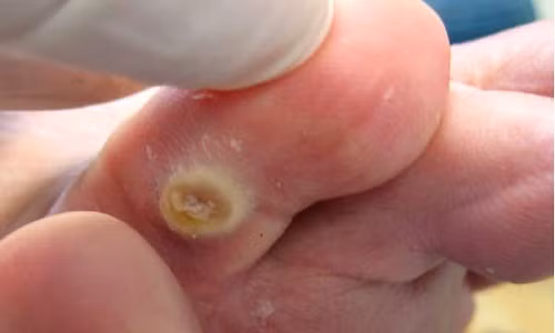 Mẹo trị mụn cóc đơn giản tại nhà