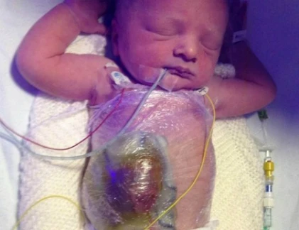 Xót lòng những bé sơ sinh có nội tạng ngoài cơ thể