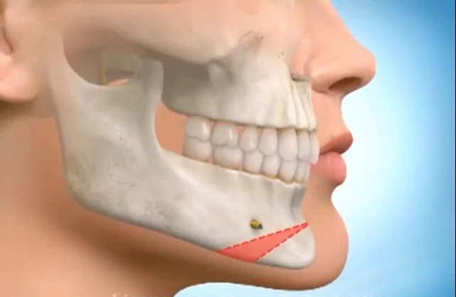 Zoom cận cảnh phẫu thuật chỉnh cằm, gọt mặt