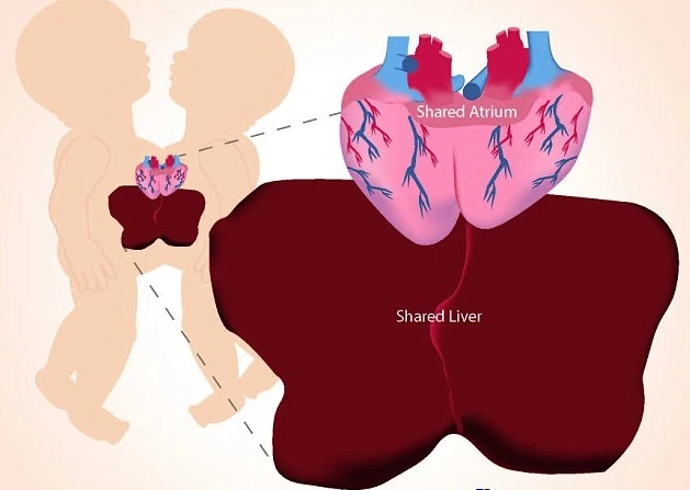 Cận cảnh ca phẫu thuật tách cặp song sinh dính liền tim