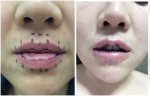 Ca dao kéo rùng rợn có 1-0-2: cắt mỏng môi cho xinh