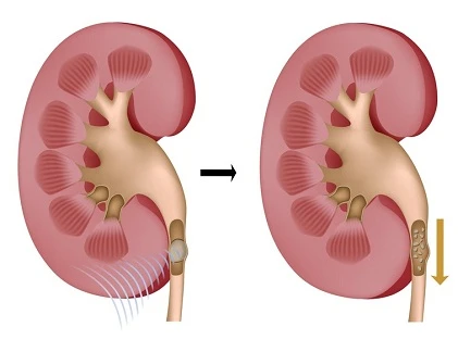 Chi tiết quy trình tán sỏi thận