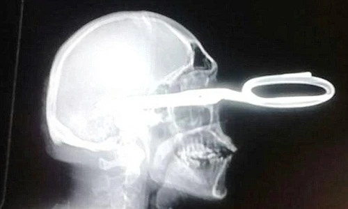 Quý ông bị đâm kéo vào đầu vẫn sống sót kỳ diệu