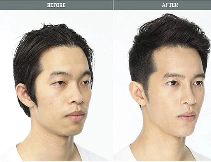 Quý ông tút tát lại nhan sắc bằng phương pháp dao kéo