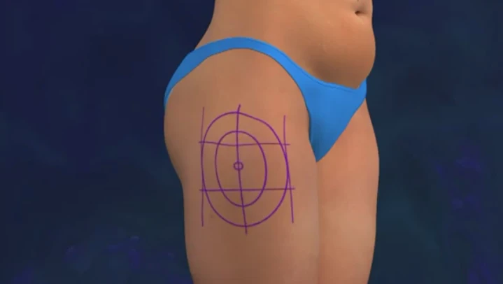 Zoom cận cảnh hút mỡ đùi bằng công nghệ Lazer