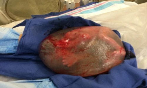 Kỳ lạ em bé sinh ra vẫn nằm trong túi ối