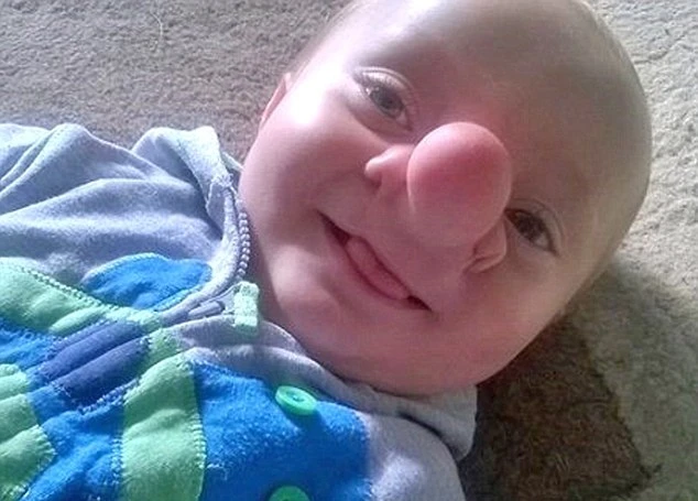 Bé 21 tháng tuổi mắc bệnh lạ có não trong mũi