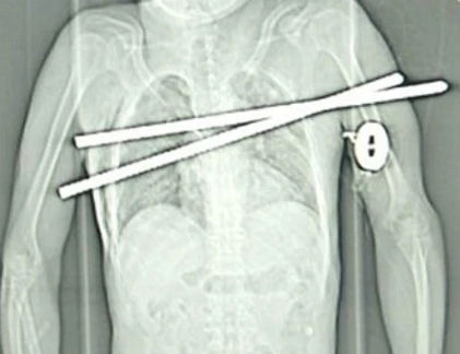 Những vụ sống sót thần kỳ dù bị đâm xuyên cơ thể