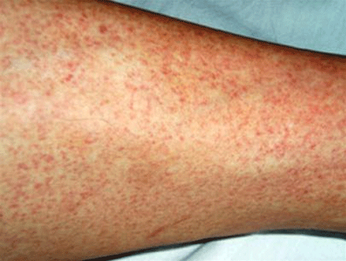 Sau đó, chúng lấy tế bào này làm nơi sản xuất một lượng lớn virion (hạt virus). Những virion này sau đó sẽ được phóng ra để nhiễm vào các tế bào khác và ngày càng lan rộng ra khắp cơ thể. Những đốm đỏ này sẽ ngày càng to khi bệnh càng nặng. Ngoài ra, chúng còn cản trở dòng máu đi nuôi các cơ quan trong cơ thể như gan, não, phổi, thận, ruột, mô vú, tinh hoàn…của bệnh nhân.