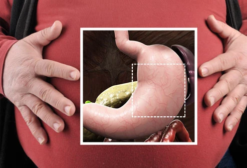 Cận cảnh phẫu thuật dạ dày giảm cân