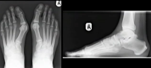 Hình ảnh 3D bàn chân chấn thương do đi giày cao gót