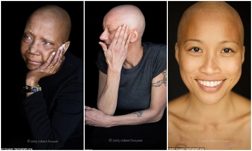 Bộ ảnh đầy cảm xúc về bệnh nhân ung thư đang hóa trị